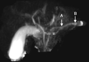 Contrast-enhanced magnetic resonance cholangiography image. A) Focal stricture zone. B) Dilation. Image of beading of the duct of Wirsung.