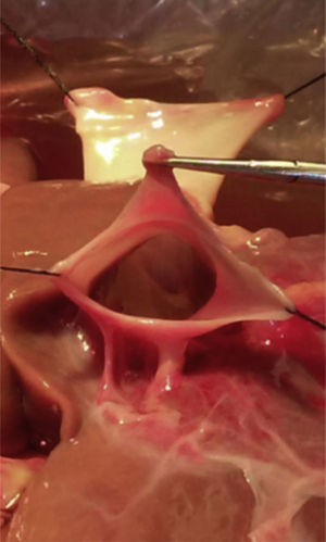 Dissected inferior vena cava.