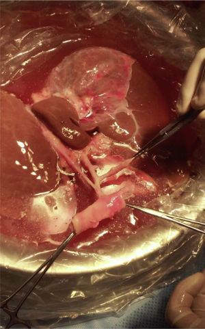 Celiac artery with its branches: splenic artery, left gastric artery, and proper hepatic artery. Notice that the left hepatic artery arises from the left gastric artery (type 2 vascular anatomy description from Couinaud's nomenclature).