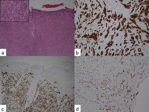 Excisional biopsy of the scalp lesion showing metastatic adenocarcinoma: a) hematoxylin-eosin stain x4, detail: hematoxylin-eosin, x40; b) immunohistochemical stain for CK7; c) immunohistochemical stain for CK19, and d) immunohistochemical stain for CDX2.