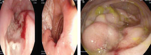 a) Upper gastrointestinal endoscopy: linear esophageal ulcers in the upper third of the esophagus. b) Lower gastrointestinal endoscopy: raised and friable lesion adjacent to the ileocecal valve, conditioning stricture.