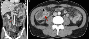 a and b) Abdominal CT images (transversal and coronal views) confirming stricturing lesion adjacent to the ileocecal valve (indicated by the red arrows).