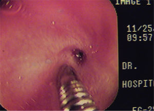 Punctiform esophageal stricture and passage of the flexible guidewire through the stricture until reaching the stomach.