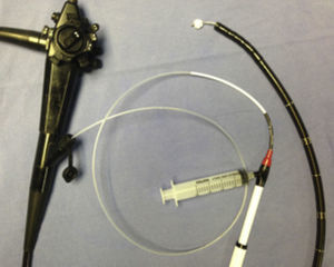 Pentax 9mm endoscope with 2.8mm operating channel through which the Dormia basket with cotton swab on the tip passes.