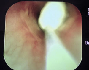 Cotton swab saturated with mitomycin C and topically applied to the dilated area.
