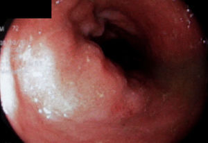 Gastroduodenal endoscopy showing white villi in the second portion of the duodenum.