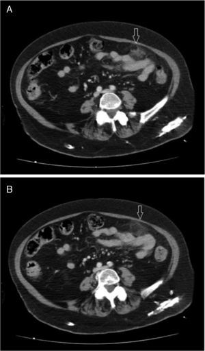 A) A 2×3mm oval-shaped image is seen at the greater omentum, near the left flank, surrounded by inflammatory changes and a small quantity of free fluid, consistent with epiploic appendagitis as a first possibility. B) A 3×3mm image, immediately adjacent to the previous image, consistent with circumscript inflammatory changes in the epiploic fat of the left flank with a small quantity of free fluid.