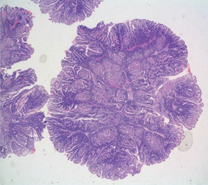 Microscopic image showing the polypoid formation of the fibroconnective branched axis with smooth muscle bands and covered by intestinal mucosa with a villous surface consistent with hamartomatous polyp.