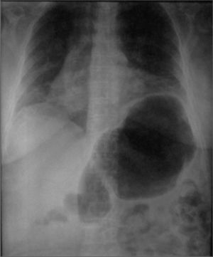 Follow-up chest x-ray showing elevation of the left hemidiaphragm due to important dilation of the gastric chamber that was not apparent in the previous x-ray.