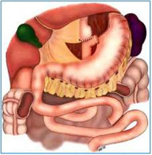 Anatomic aspect of Roux-en-Y gastric bypass.