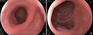 Endoscopic aspect of the Roux-en-Y gastric bypass. a) Gastric pouch. b) Gastrointestinal anastomosis.