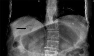 Chest x-ray showing the gastric distension and pneumobilia (black arrow).