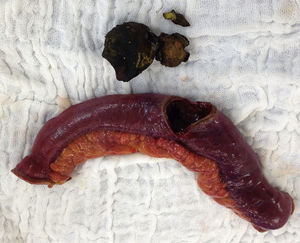 Image of the surgical specimen and stone.