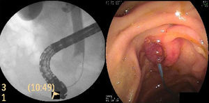 Cholangiography: obstructive endoluminal image in the distal third of the common bile duct. Endoscopy: Endoloop® placement in the pedicle of the lesion.
