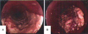 A) Tumor in the middle third, showing increased plaque growth. B) Tumor in the lower third showing elevated annular and stenosing growth.