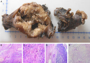A) Segment of the middle and distal esophagus showing tumor formation with annular and infiltrative growth up to the serosa that almost completely obstructs its lumen. B and C) Squamous cell carcinoma with intercellular bridges, corneal pearls, dyskeratotic cells, and atypical mitoses. D) Lymph node metastasis. E) Areas of periesophageal tissue with neoplastic nodules of moderately differentiated squamous cell carcinoma (with no intercellular bridges, corneal pearls, or keratin (H&E stain).