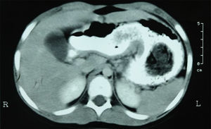 Double-dose contrast-enhanced computed axial tomography scan showing the presence of an intragastric tumor with spirals of varying densities, alternating with air and partial passage of the water-soluble contrast medium.