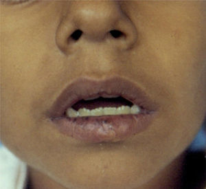 Hyperchromic macules on the lips.