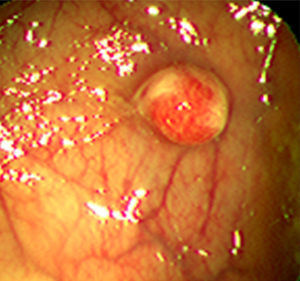 Endoscopic image of the hamartomatous colonic polyp in the patient.