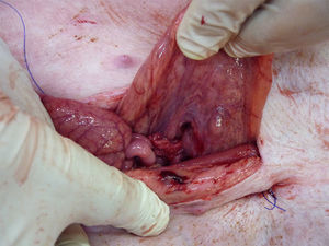 Exploratory laparotomy after the procedure.