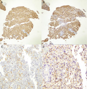 Immunohistochemical analysis. A) Positive immunoreaction to CD45 in neoplastic lymphocytes and in reactive B and T lymphocytes. B) Positive immunoreaction to CD20 in neoplastic lymphocytes. C) Focally positive Bcl-6 immunoreaction in neoplastic cells. D) Focally positive immunoreaction for Kappa in neoplastic cells.