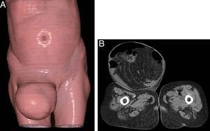A) Coronal Computed Tomography Volume Rendering Technique image that demonstrates the presence of the large right inguinal hernia. B) Axial Computed Tomography image that shows a direct hernia passing through the inguinal canal with bowel segment protrusion.