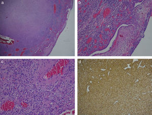 Histopathology analysis with inflammatory fibroid polyp diagnosis: a) amplification (x20), b) amplification showing granulated tissue with a proliferation of spindle cell elements (x100), c) amplification showing small, thick capillaries and a mixed inflammatory infiltrate with eosinophils (x200), and d) amplification with staining positive for CD34 (x40).