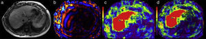 Magnetic resonance elastography images: a) reference image, b) wavelength map, c) elastographic map, d) elastographic map with an overlying grid that marks the limits of the safety area for carrying out the measurements.