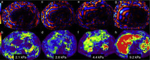Information analysis. The wavelength map in 4 patients with different grades of stiffness is in the upper row. The lower row corresponds to the elastographic or color map of each of them. Figures a, c, e, and g show the increase in thickness and the irregularity of the wavelengths as the grades of fibrosis increase. The elastographic maps show the changes in color of the liver and their respective stiffness measurements: b) purples for 2.1kPa=F 1; d) greens and blues for 2.6kPa=F2; f) greens and yellows for 4.4kPa=F3; and h) red for 9.2kPa=F4. Compare the colors of the liver with the color bar on the left side.