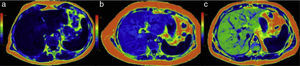 Color maps in 3 patients with different steatosis grades: a) patient with normal fat content: the dark blue of the liver corresponds to the lower part of the colorimetric scale and to a quantification below 6% (normal); b) in this patient the light blue is higher on the scale and the fat content is increased to an average 17%; c) the image in the third patient assigned green to the liver, which is indicative of a high fat content and was quantified at 33%.