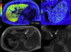 Hemochromatosis. a) In the colorimetric map, the reds correspond to the higher part of the scale, indicating greater iron concentration in the liver parenchyma. b) Also note the red dot in the amplified image of the spleen produced by the Gamna-Gandy siderotic bodies. c) In addition, the anatomic image in T1 of this patient showed decay of the parenchymal signal of the pancreas (arrow) and the presence of enlarged peripancreatic lymph nodes (arrows) in relation to the hemochromatosis (d).