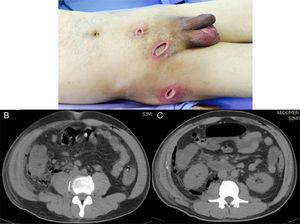 A) Important soft tissue infection is shown that extends from the suprapubic incision to the right inguinal region, and to the right scrotal region and flank, all with significant purulent matter. B) Tomographic image showing the retroperitoneal abscess extending proximally until reaching the costal ridge, with the presence of gas in its entire extension. C) Image showing the retroperitoneal abscess at the level of the cecum that extended through Toldt's fascia, with the presence of gas at this level.