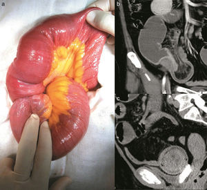 (a) Small bowel segment with ileo-ileal intussusception, (b) Coronal view of contrast-enhanced CAT scan showing retraction of fat and mesenteric vessels, and (c) Sagittal view of contrast-enhanced CAT scan showing the “target sign” image.