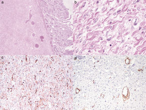 (a) Histologic slice showing an ulcerated lesion located in the submucosa (hematoxylin & eosin stain x2). (b) Thick collagen bundles and spindle cells with fine granular chromatin nuclei are seen in the lesion (hematoxylin & eosin stain, x40). (c) Immunoreaction positive for CD34. (d) Negative smooth muscle actin.