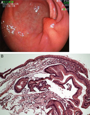 A) Follow-up endoscopy 6 months after ESD, demonstrating fold convergence and an aberrant polypoid nodule at the scar. B) Histology revealed regenerative hyperplastic tissue.