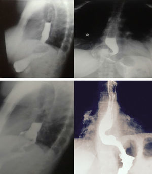 Wrap slippage with change of direction (angulation) and supra-stenotic dilation.