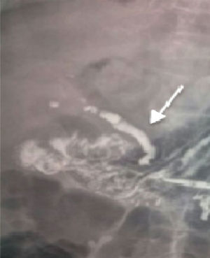 Contrast-enhanced abdominal film showing the Petren sign (arrow).