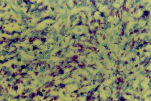 High-magnification photomicrograph with Ziehl-Neelsen stain showing tubercle bacilli.
