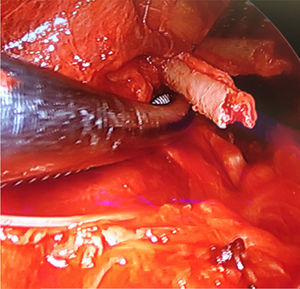 Endoscopic image during the surgery.