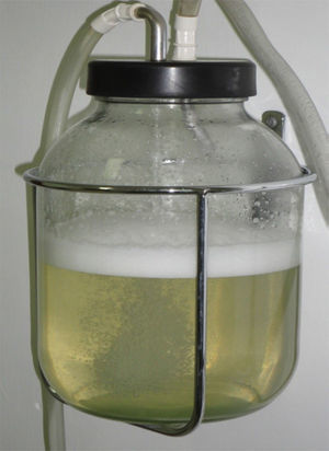 Citrine characteristics of the intracystic fluid. Eleven liters were obtained.