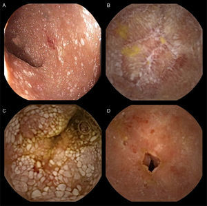 A) Mucosal edema of the terminal ileum with superficial whitish spots and nonspecific chronic inflammation in the histology report. B) The presence of multiple ulcers that distorted and strictured the intestinal lumen. C) Distal segments through which the device passed with no difficulty. (D) Post-radiation enteritis is shown.