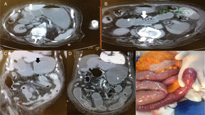 Patient No. 2 with intermittent bowel obstruction. A) Non-contrasted axial tomography showing the porcelain gallbladder with wall thickening, air inside the gallbladder (small arrow), adhered to the primary portion of the duodenum with its edematous wall (large arrow), and important distention of the rest of the duodenum and stomach. B) Lower axial view showing dilated jejunum segments with edema (small arrow), intestinal pneumatosis (large arrow), and 29mm calcified intraluminal stone. C) Coronal view of the same patient showing pneumobilia, adherence of the gallbladder to the duodenum (white arrow), gastric and duodenal distention (black arrow) proximal to the intraluminal stone in the jejunum and collapse of the distal segments (red arrow). D) Coronal view of serial non-contrasted tomography, 12 days after the previous images. Migration of the stone into the terminal ileum and free fluid in the cavity can be observed. E) Intraoperative image showing bowel obstruction from the intraluminal stone at the level of the ileum, with hyperemia and edema of the intestinal wall.