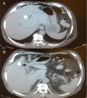 Patient No. 3 that presented with moderate acute cholangitis. A) Axial view of the abdomen showing pneumobilia in the intrahepatic bile duct (white arrow). B) The same patient, axial view, showing the contracted gallbladder, air inside the gallbladder (short arrow), and its adherence to the duodenum (large arrow).