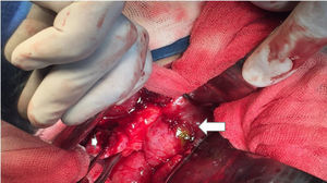 Intraoperative image of Patient No. 3 showing the porcelain gallbladder with opening in the fundus, where there are remnants of the small fistulous tract (small arrow), duodenum with important edema, its opening, and tissue remnants of the fistulous tract (large arrow).