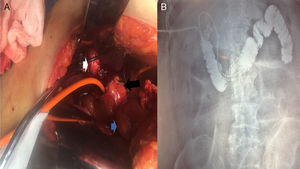 A) Intraoperative image of Patient No. 4 that presented with severe cholangitis, showing the porcelain gallbladder (white arrow), which was adhered to the complex fistulous tract (black arrow). The Nelaton catheter was placed inside it, which in turn, communicated with the first portion of the duodenum (blue arrow). B) Fistulography through the Nelaton catheter of the same patient, using water soluble contrast medium carried out 24h after the surgical procedure. The insertion of the catheter that passes through the fistulous tract is observed, adhered to the first portion of the duodenum, reaching the third and fourth portions. After the contrast medium was administered, the duodenal-jejunal junction can be seen up to the fixed ligament of Treitz. The knee and second portion of the duodenum are filled with contrast medium reflux.