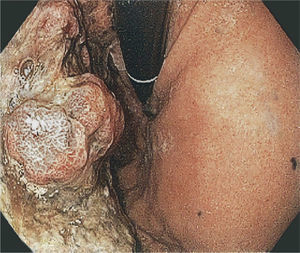 Image in retroversion, ulcerated neoplastic lesion.
