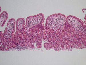 Intraepithelial lymphocytosis associated with loss of mucus secretion vacuoles, glandular crypt hyperplasia, and moderate villous atrophy (H&E x20).