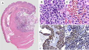 A) Comprehensive image of the intramural lesion. B and C) Round, uniform cells with central oval nuclei, homogeneous granular chromatin, clearly delineated and eosinophilic small nucleolus of the cytoplasm. D) Immunohistochemistry positive for smooth muscle actin. E) Immunohistochemistry positive for synaptophysin in perivascular glomus cells.