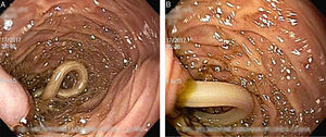 A and B) Nematode occluding the ampulla of Vater.