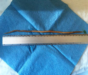 Ascaris lumbricoides measuring 27cm in length.